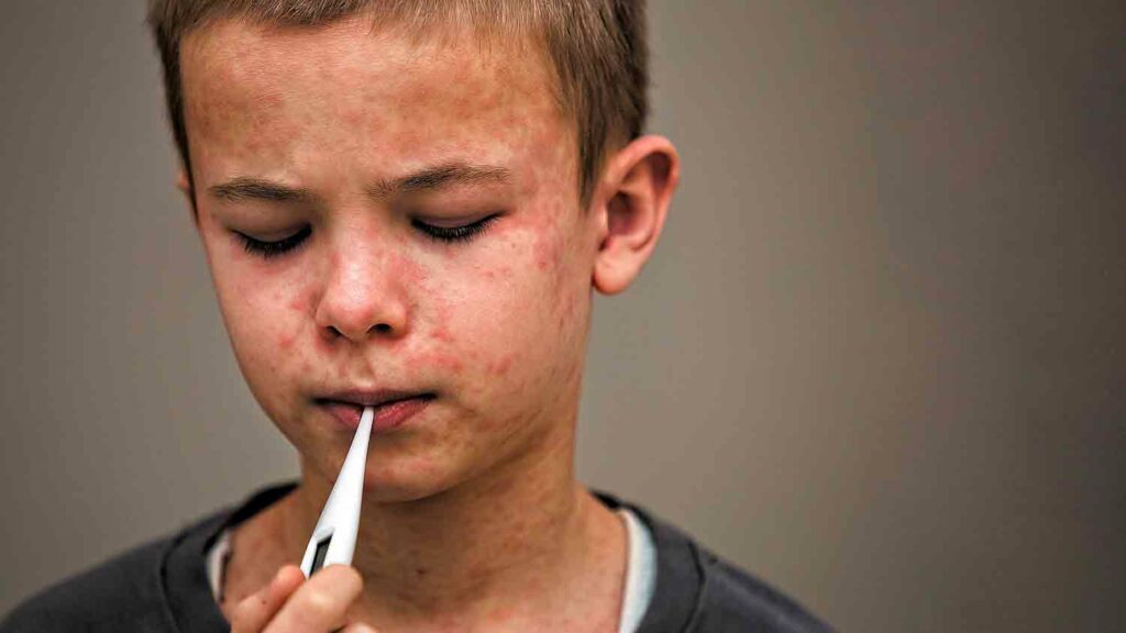 child with measles rash and thermometer