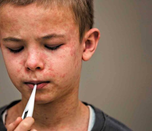 child with measles rash and thermometer